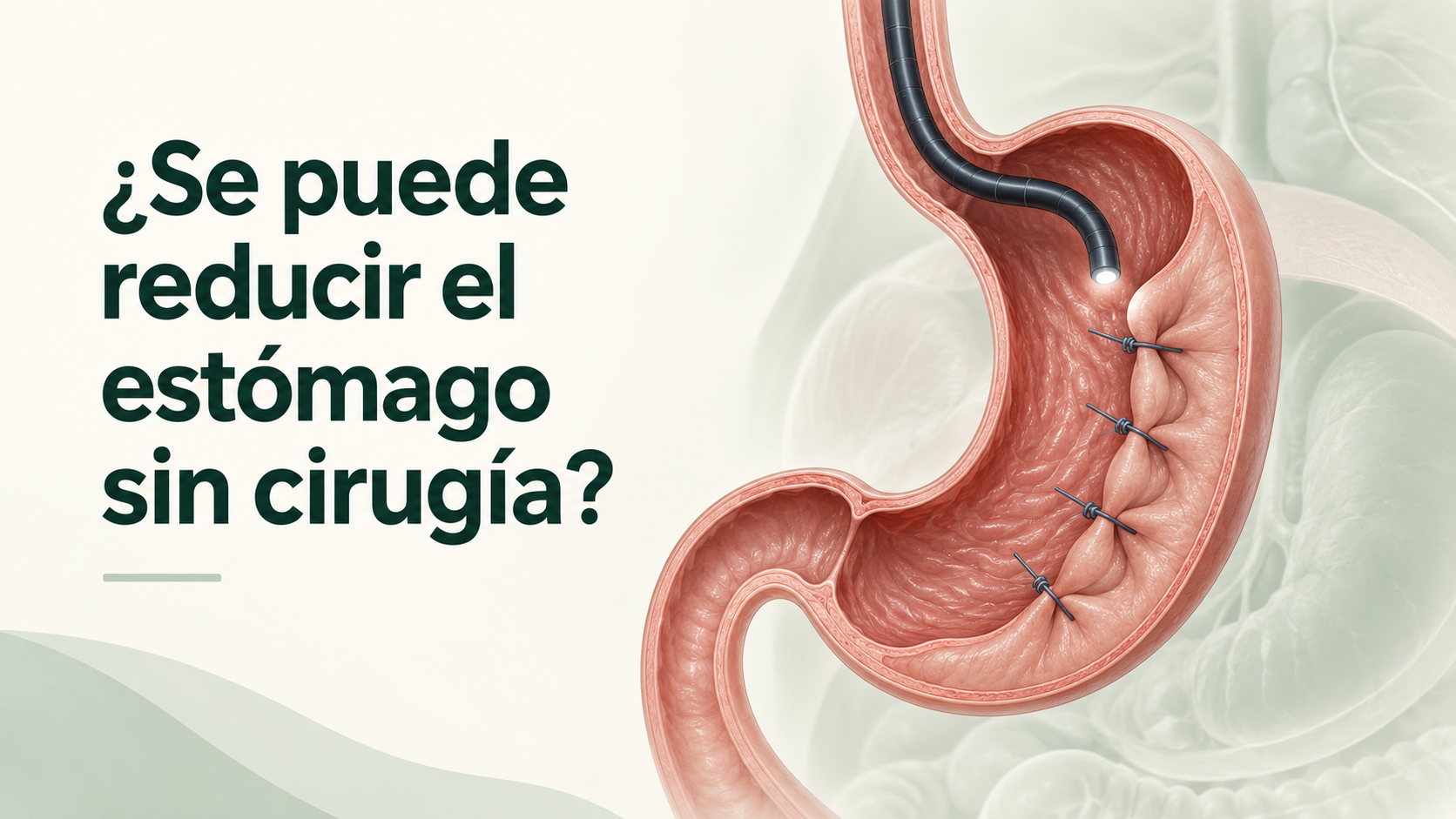 Gastroplastia endoscópica con suturas internas para reducir la capacidad del estómago